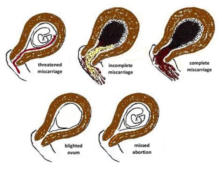 What causes miscarriage after amniocentesis