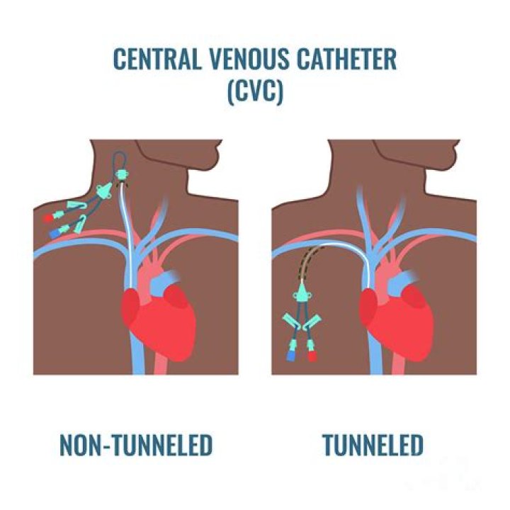 What is a catheter lumen