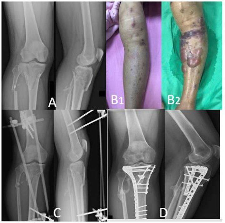 What is the treatment for a tibial plateau fracture